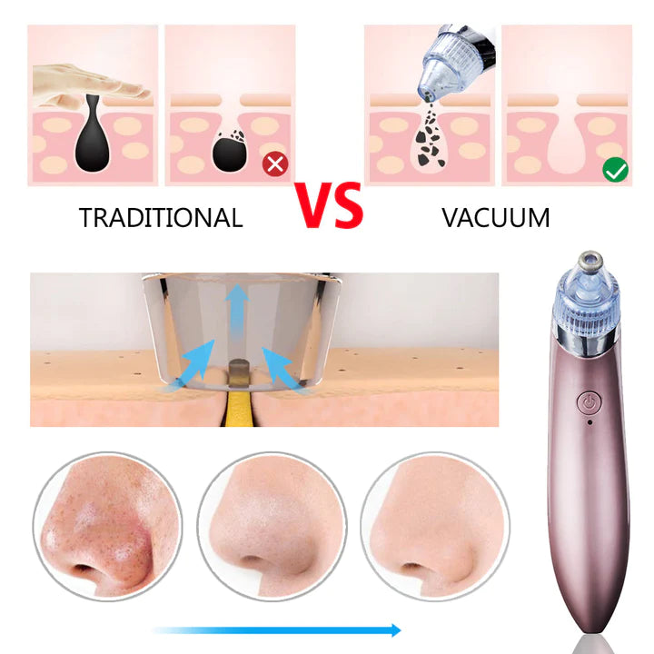 Aspirator Vacuum Facial Cleanser pentru Curatarea Tenului, aspirare si curatire cosuri, puncte negre, pori, acnee